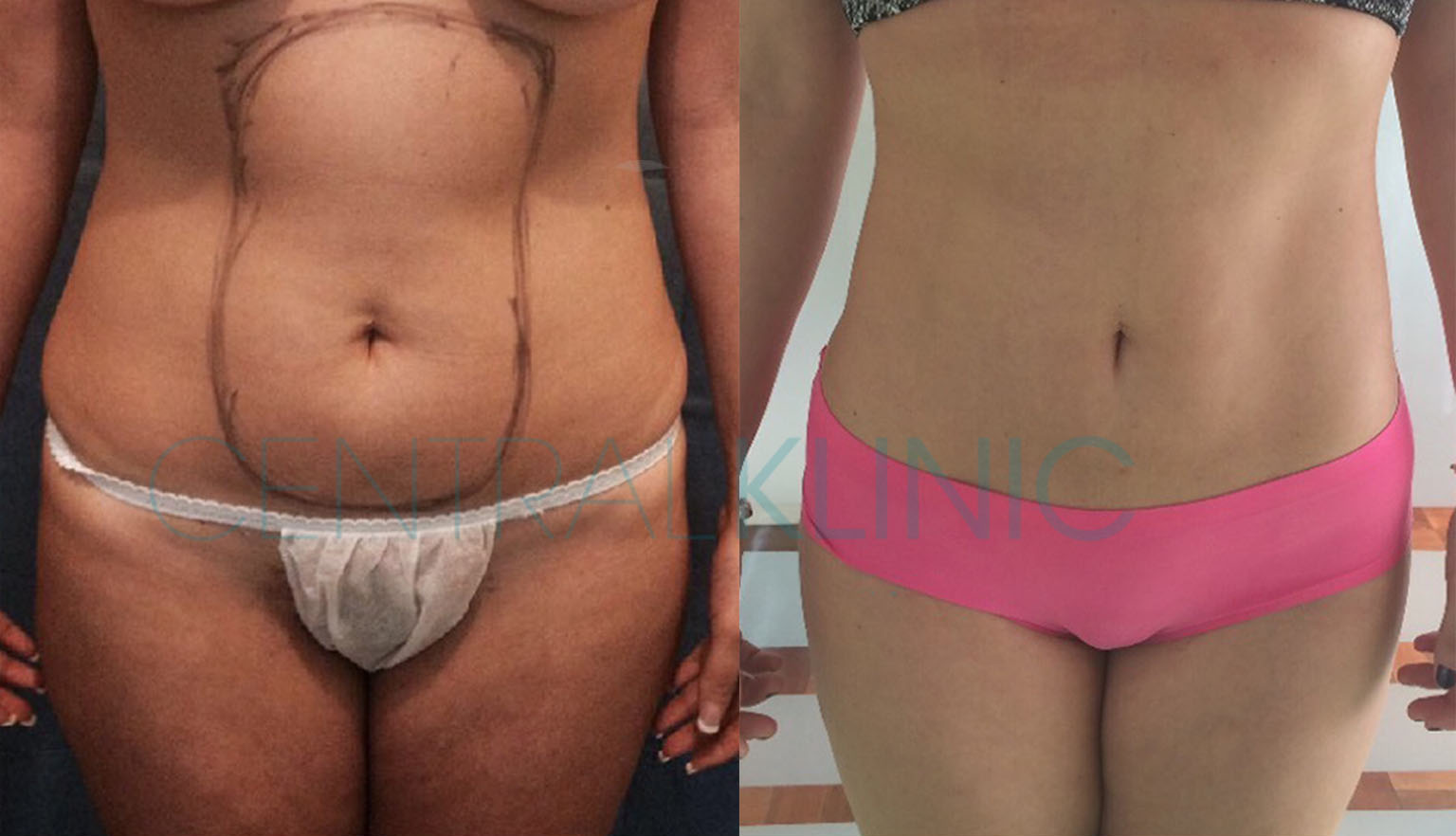 Liposucción antes y después Frente