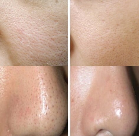 Poros Dilatados Laser Spectra Tratamientos Central Klinic
