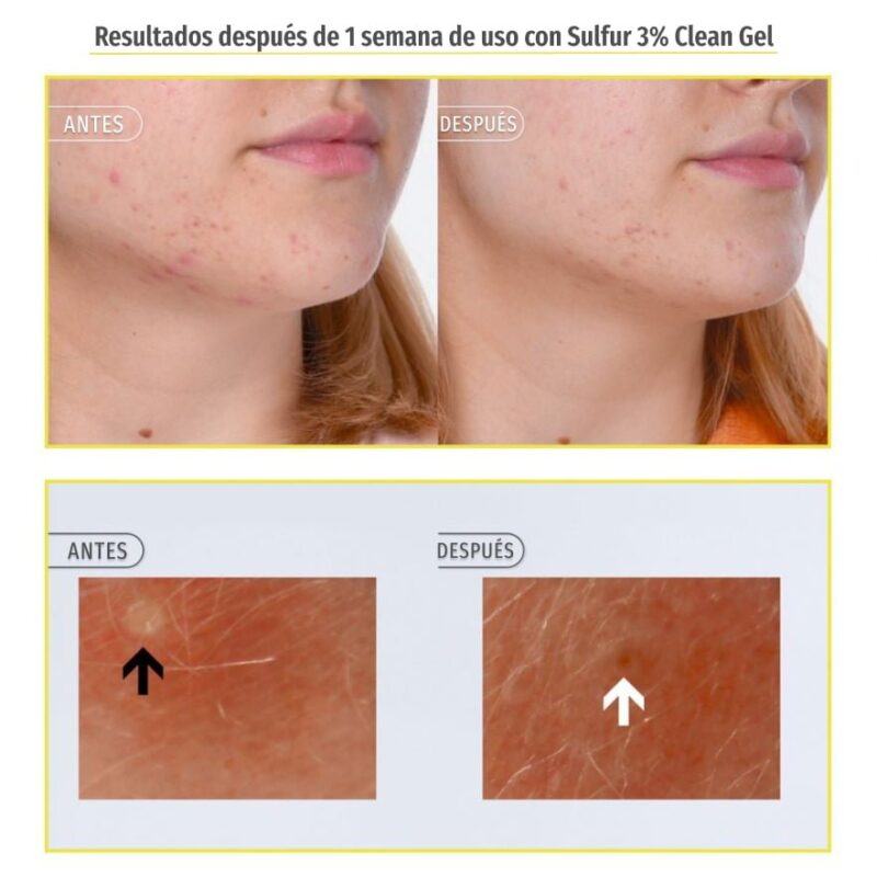 Sulfur 3% Clean Gel