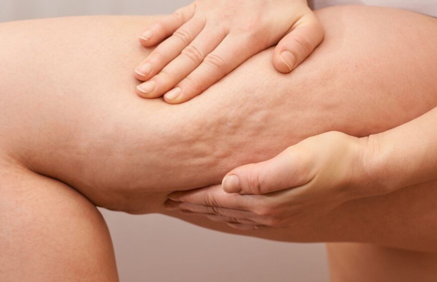 celulitis-muslo