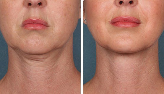 Resultados HIFU 4D Ultra Facial