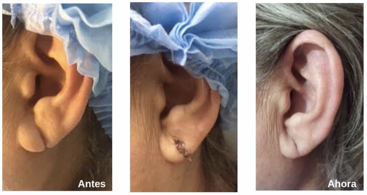 lobuloplastia-antes-despues