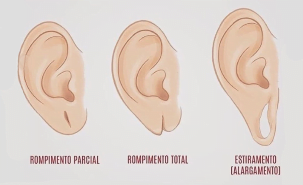 Tipos de Lobuloplastía