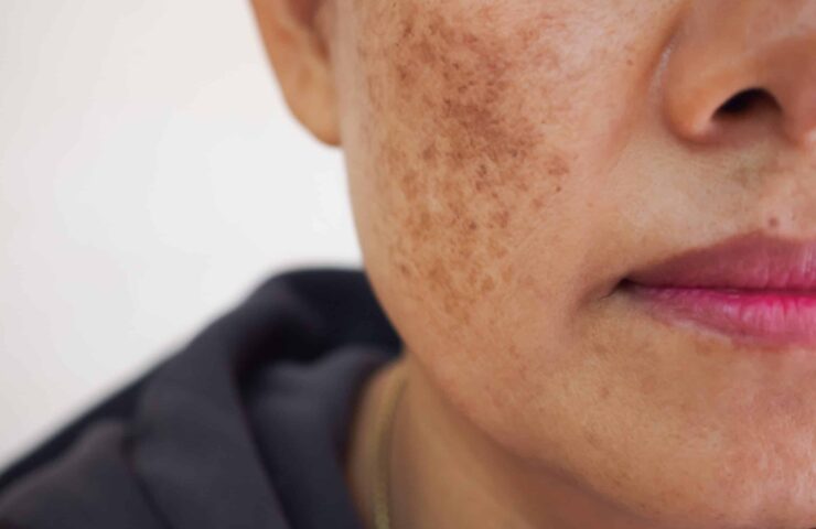 melasma cloasma pigmentacion embarazadas