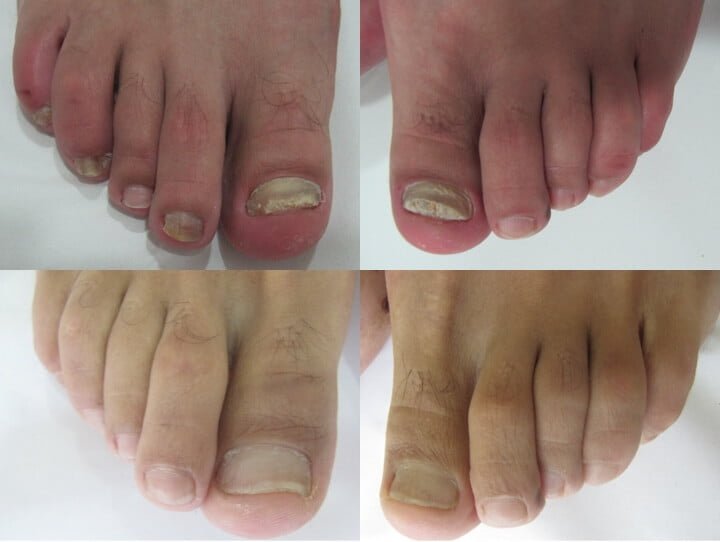 Onicomicosis Resultados