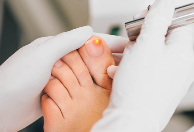 Onicomicosis Tratamiento Láser