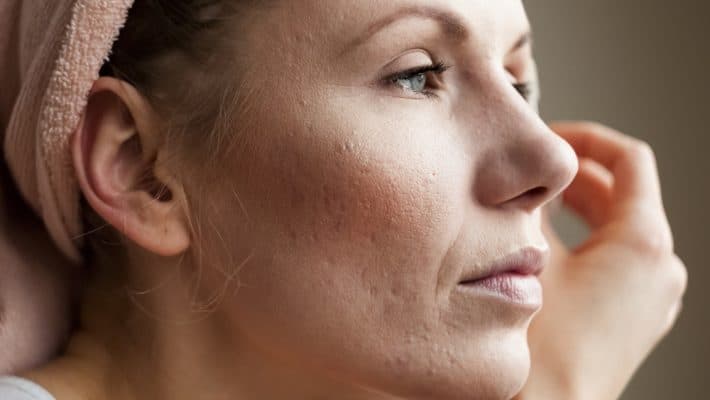 quitar-marcas-de-acne-710×400-1
