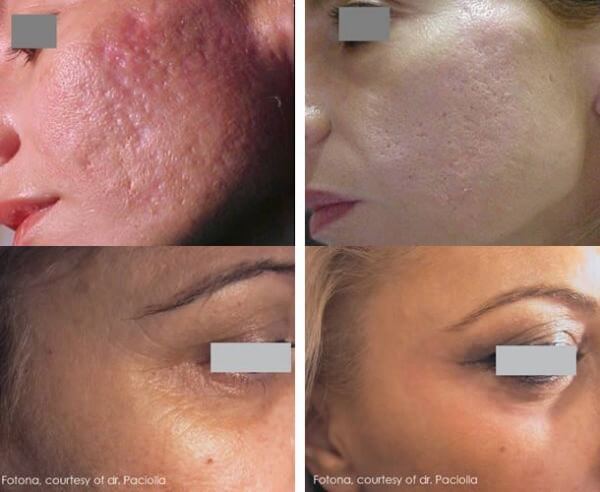 resurfacing-laser-antes-y-despues