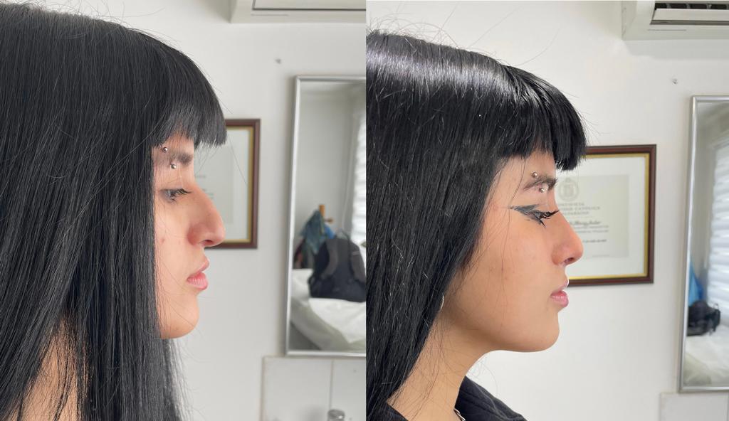 Rinoplastia Parcial Antes y Después