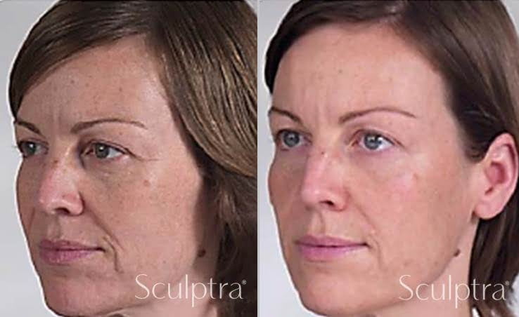 Resultados Sculptra Facial