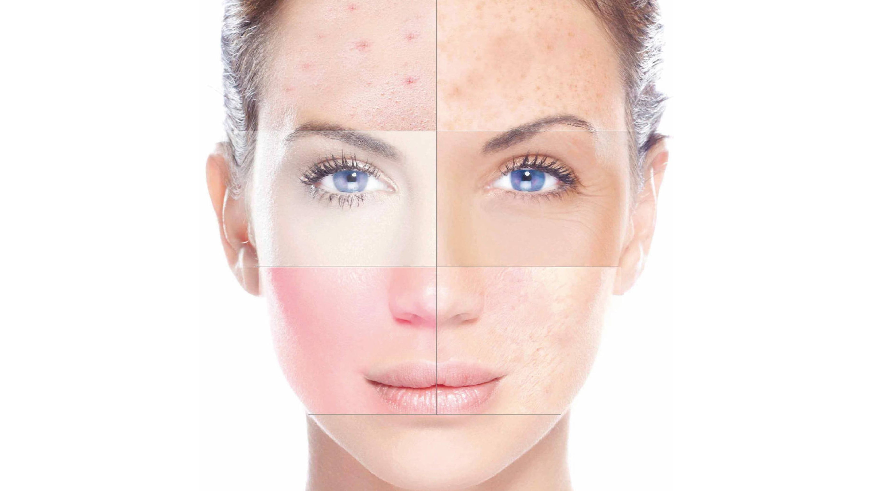 Cicatrices / Arrugas – Resurfacing Láser