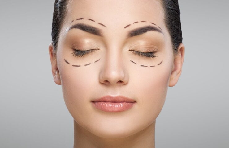Blefaroplastia