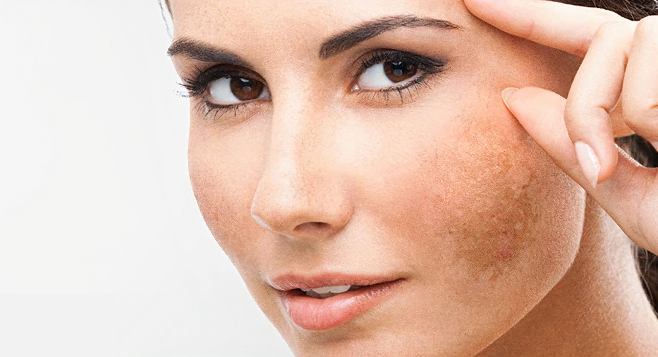 Melasma – Láser Spectra