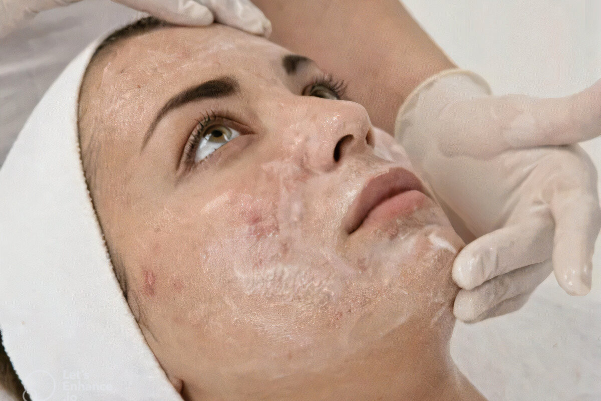 Limpieza Facial Acné