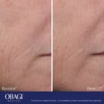 ELASTIderm Advanced Filler Concentrate
