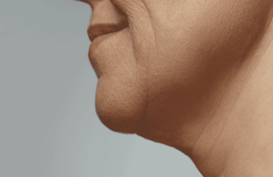 OZEMPIC-FACE-BLOG
