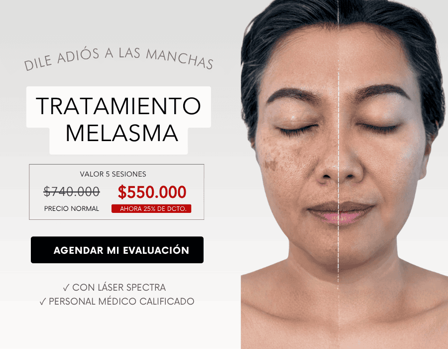 Tratamiento Melasma manchas movil