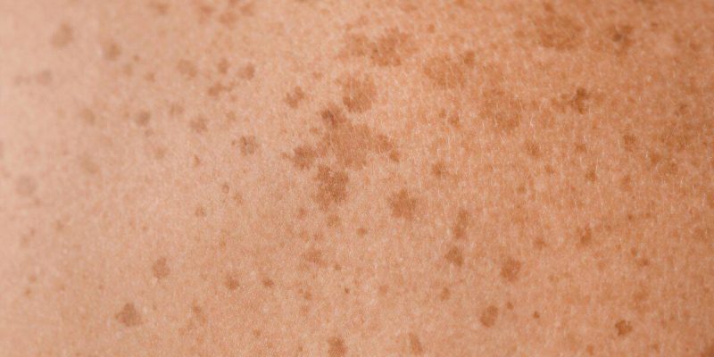 Melasma Lentigo Solar