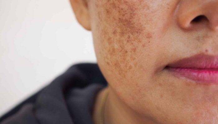 melasma cloasma pigmentacion embarazadas